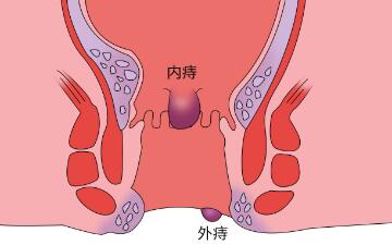 痔疮是什么样子的（痔疮怎么治疗最好方法 男性）