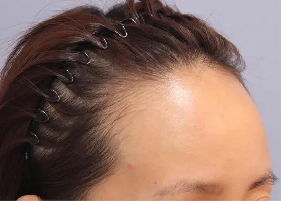 发际线太高了怎么办什么发型可以拯救发际线呢
