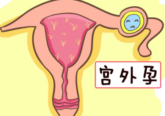 宫外孕的症状有哪些表现（上环宫外孕的症状有哪些表现）
